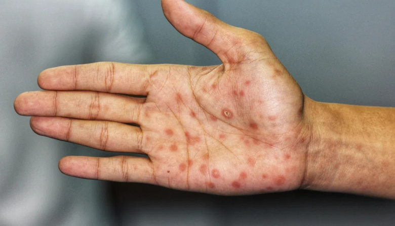 Aumentan los contagios de sífilis en Perú