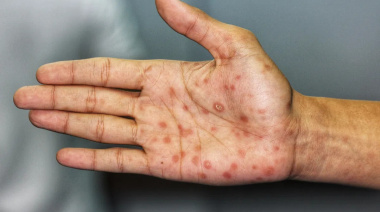 Aumentan los contagios de sífilis en Perú